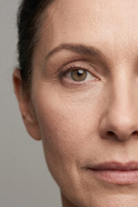 Chemical Peels